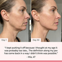 Before and after Day 1 to Day 30 – Mia, 47, jawline definition